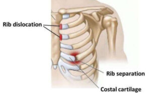 דמיאן לילארד סובל מצלעות מופרדות (SEPARATED RIB) / מנחם לס